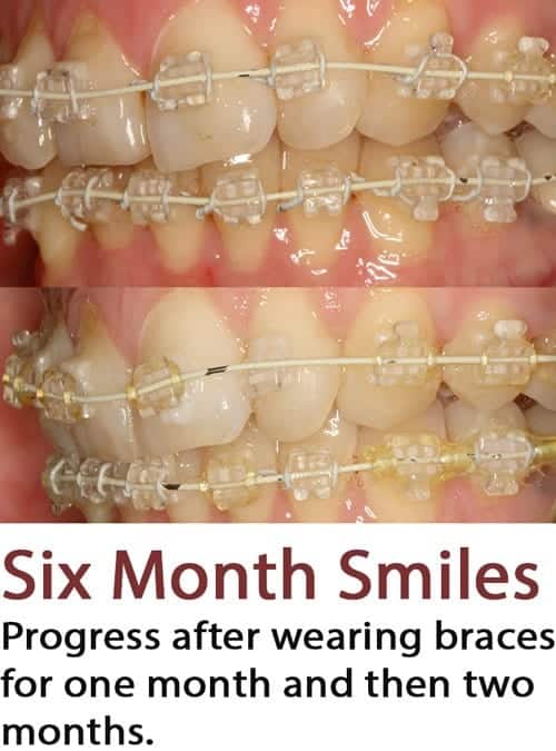 Adult Braces With Six Month Smiles Update